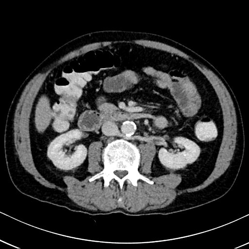 Chronic appendicitis complicated by appendicular abscess, pylephlebitis and liver abscess (Radiopaedia 54483-60700 B 75).jpg