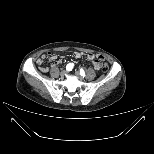 File:Chronic contained rupture of abdominal aortic aneurysm with extensive erosion of the vertebral bodies (Radiopaedia 55450-61901 A 54).jpg