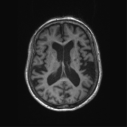 Chronic hypertensive encephalopathy (Radiopaedia 72844-83495 Axial T1 33).png