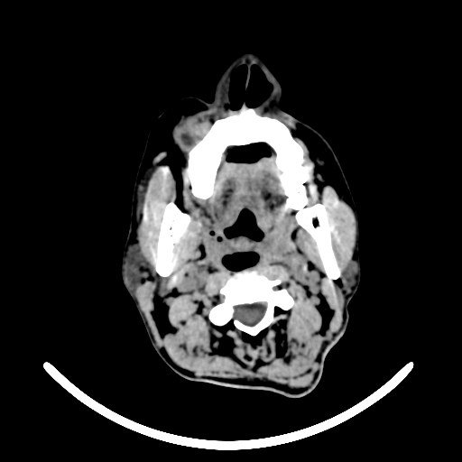 File:Chronic invasive fungal sinusitis with intraorbital and intracranial extension (Radiopaedia 56387-63046 Axial non-contrast 15).jpg
