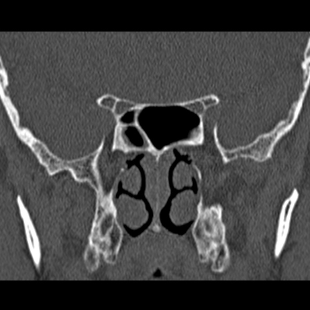 Chronic maxillary sinusitis (Radiopaedia 27879-28116 Coronal bone window 40).jpg