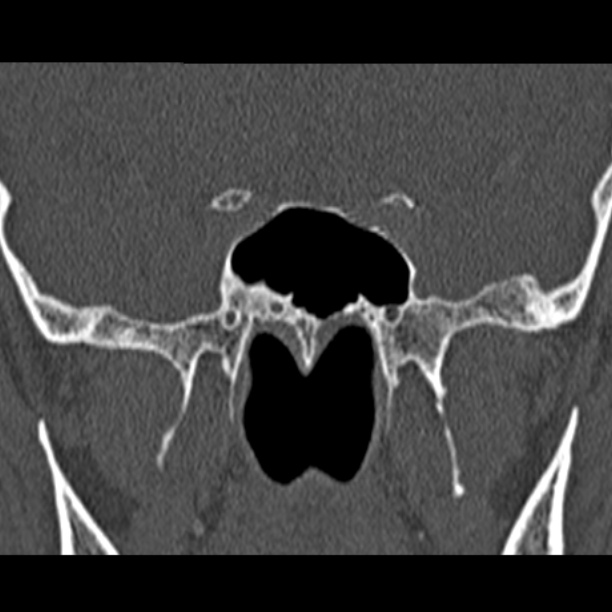 Chronic maxillary sinusitis (Radiopaedia 27879-28116 Coronal bone window 45).jpg