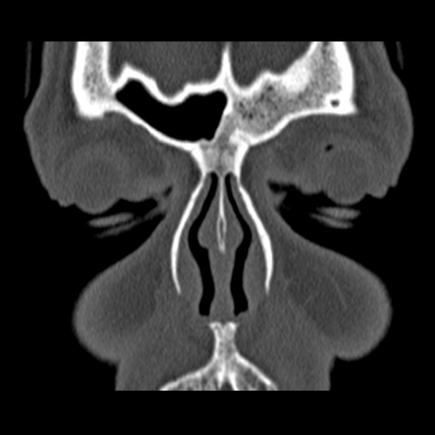 Chronic maxillary sinusitis (Radiopaedia 27879-28116 Coronal bone window 9).jpg