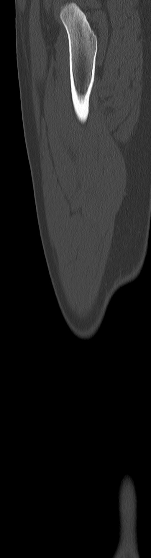 Chronic ostemyelitis of the femur with long sinus tract (Radiopaedia 74947-85982 Sagittal bone window 26).jpg