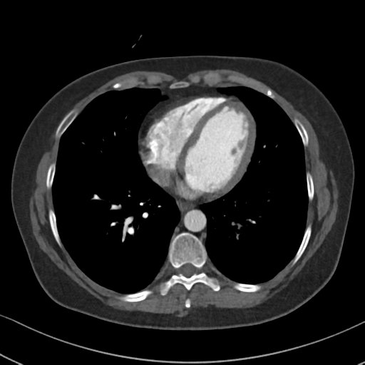 File:Chronic pulmonary embolus (Radiopaedia 39129-41341 Axial C+ CTPA 69).png