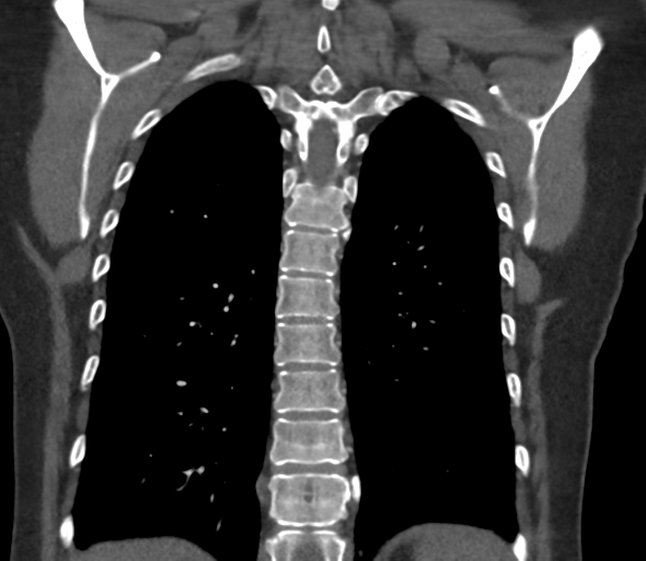 Chronic pulmonary embolus (Radiopaedia 39129-41341 Coronal C+ CTPA 65).png