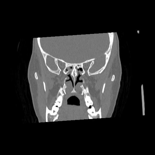 File:Chronic sinusitis with intra-sinus calcification (Radiopaedia 63919-72668 Coronal bone window 17).jpg