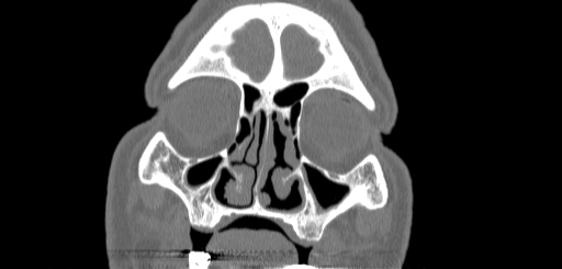 Chronic sphenoidal sinusitis (Radiopaedia 62030-70122 Coronal bone window 33).jpg