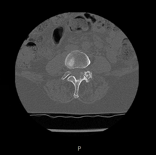 File:Chronic spinal hematoma with cauda equina syndrome (Radiopaedia 75745-88197 Axial bone window 37).png