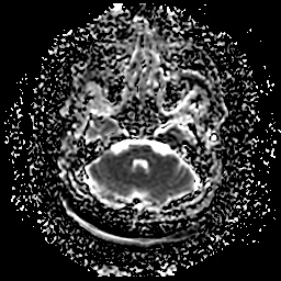 File:Chronic submandibular sialadenitis (Radiopaedia 61852-69885 Axial ADC 3).jpg
