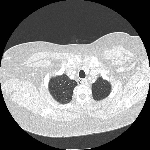 Cicatrisation collapse (Radiopaedia 17405-17089 lung window 14).jpg