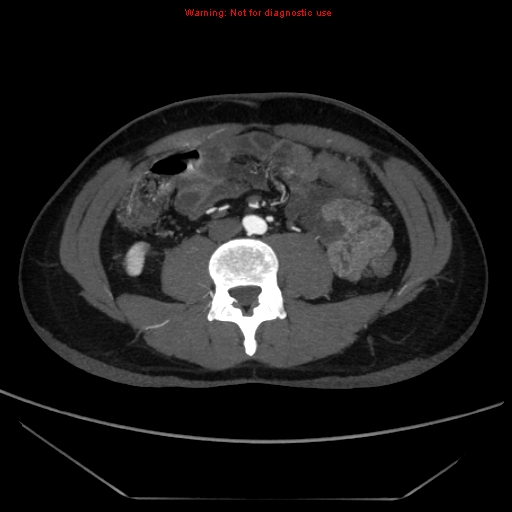 File:Circumaortic left renal vein (Radiopaedia 9069-9792 A 41).jpg