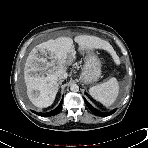 Cirrhosis and hepatocellular carcinoma in the setting of hemochromatosis (Radiopaedia 75394-86595 B 26).jpg
