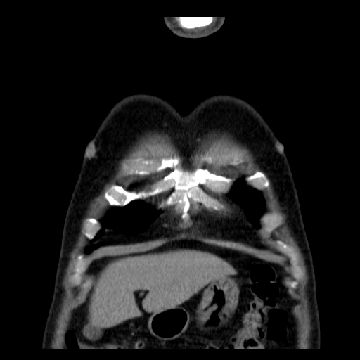 File:Classic complicated silicosis (Radiopaedia 49720-54961 Coronal liver window 1).jpg