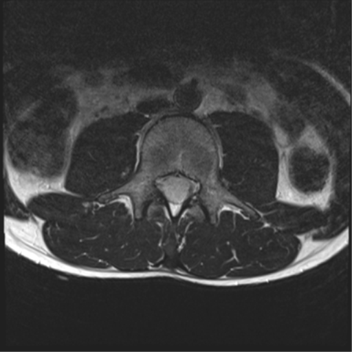 File:Clear cell meningoma - lumbar spine (Radiopaedia 60116-67690 Axial T2 23).png