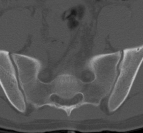 Clear cell meningoma - lumbar spine (Radiopaedia 60116-67691 Axial bone window 76).png