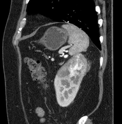 File:Clear cell renal cell carcinoma (Radiopaedia 61449-69393 D 14).jpg