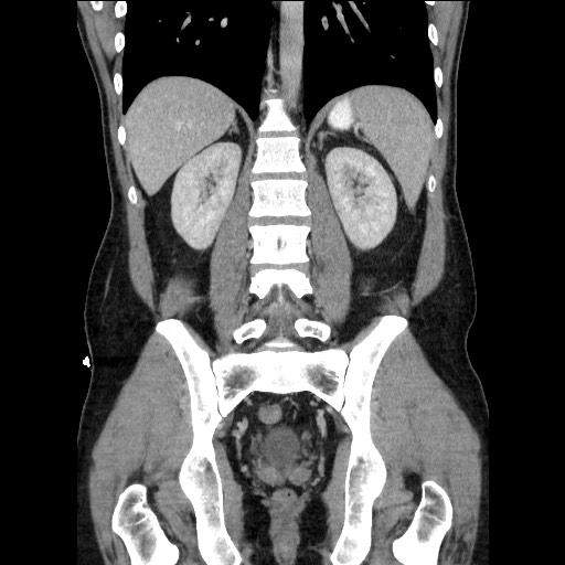 Closed-loop small bowel obstruction (Radiopaedia 73713-84509 C 85).jpg