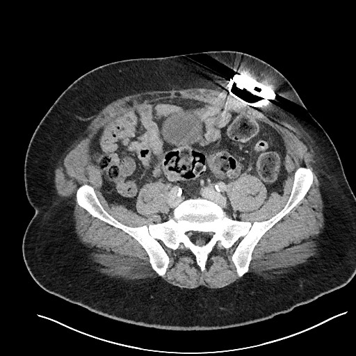 File:Closed loop obstruction - internal hernia into nephrectomy bed (Radiopaedia 59867-67320 A 102).jpg