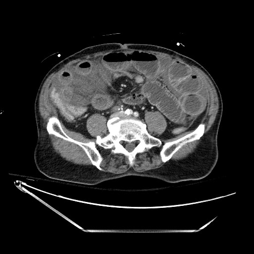 File:Closed loop obstruction due to adhesive band, resulting in small bowel ischemia and resection (Radiopaedia 83835-99023 Axial 382).jpg