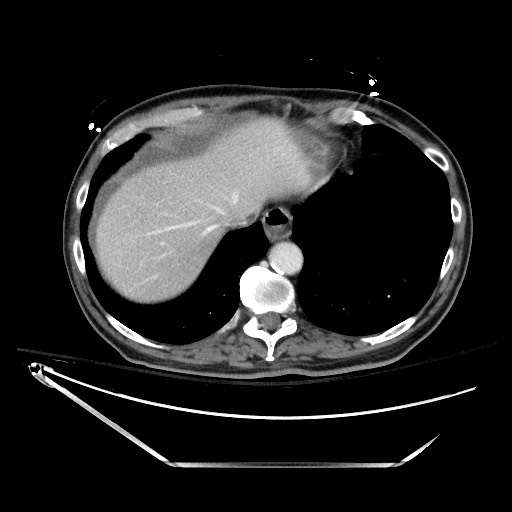 File:Closed loop obstruction due to adhesive band, resulting in small bowel ischemia and resection (Radiopaedia 83835-99023 D 25).jpg