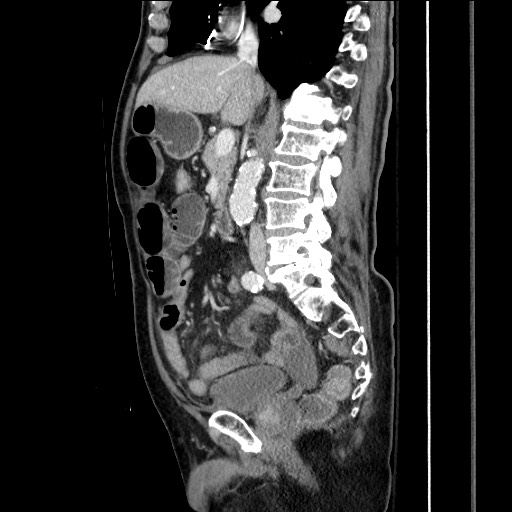 File:Closed loop obstruction due to adhesive band, resulting in small bowel ischemia and resection (Radiopaedia 83835-99023 F 89).jpg