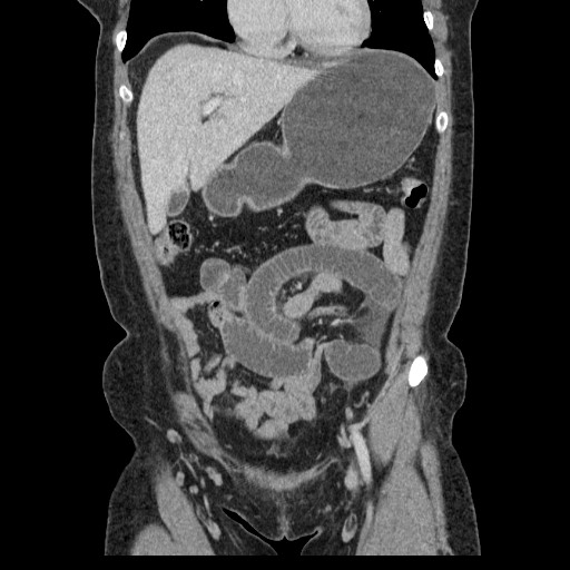 File:Closed loop small bowel obstruction (Radiopaedia 65403-74451 B 40).jpg