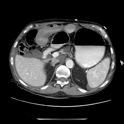 Closed loop small bowel obstruction - adhesive disease and hemorrhagic ischemia (Radiopaedia 86831-102990 A 61).jpg