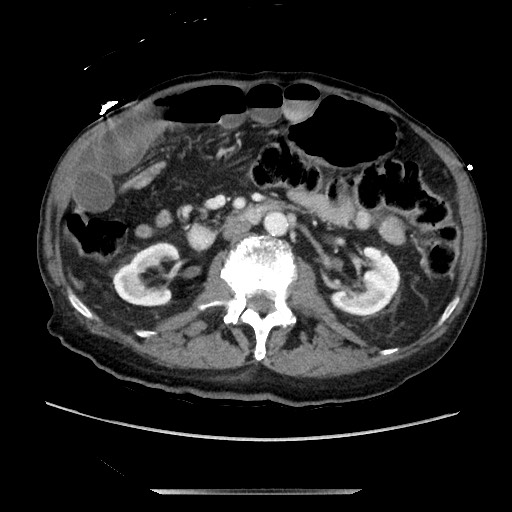 Closed loop small bowel obstruction - adhesive disease and hemorrhagic ischemia (Radiopaedia 86831-102990 A 88).jpg