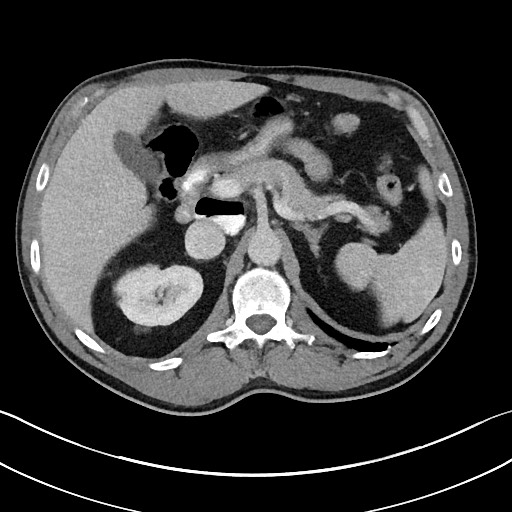 File:Closed loop small bowel obstruction - internal hernia (Radiopaedia 57806-64778 Axial 79).jpg