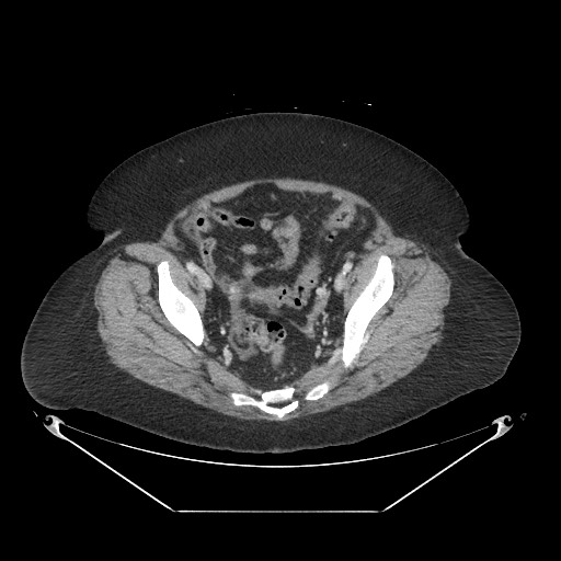 Closed loop small bowel obstruction - internal hernia (Radiopaedia 65402-74450 A 111).jpg