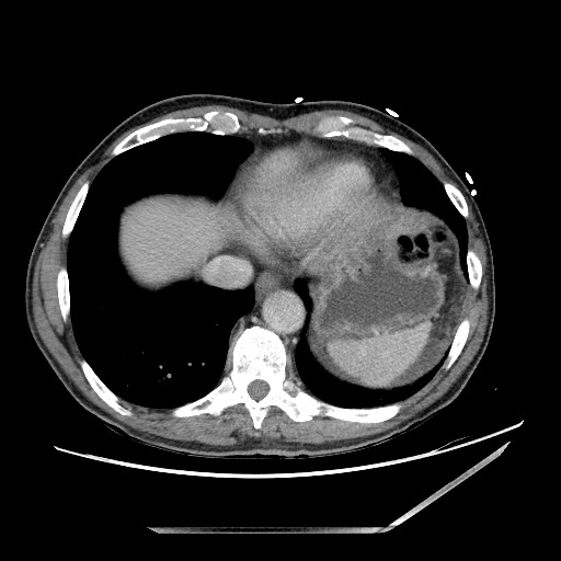 Closed loop small bowel obstruction - omental adhesion causing "internal hernia" (Radiopaedia 85129-100682 A 14).jpg