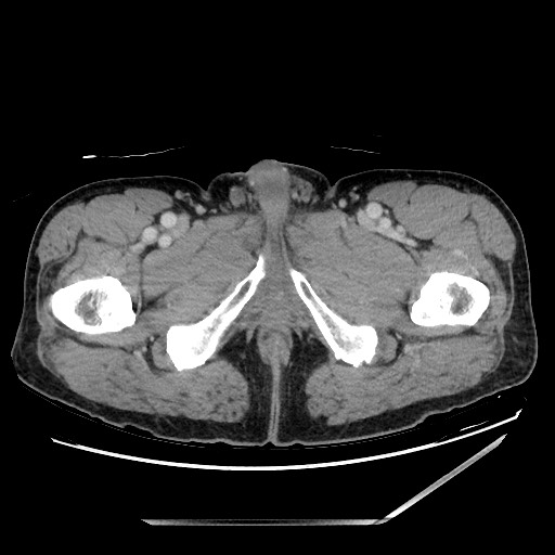 Closed loop small bowel obstruction - omental adhesion causing "internal hernia" (Radiopaedia 85129-100682 A 185).jpg