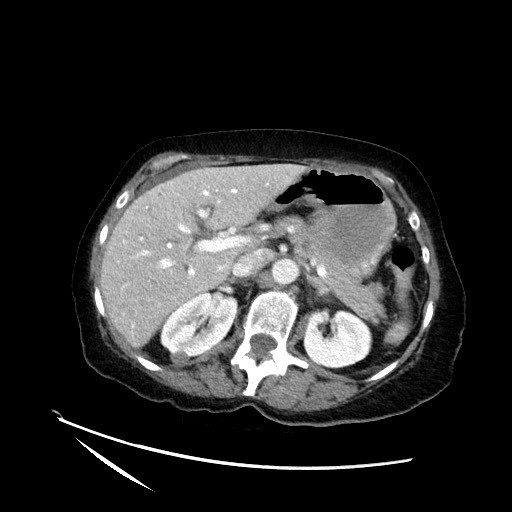 File:Closed loop small bowel obstruction due to adhesive band, with intramural hemorrhage and ischemia (Radiopaedia 83831-99017 Axial 73).jpg