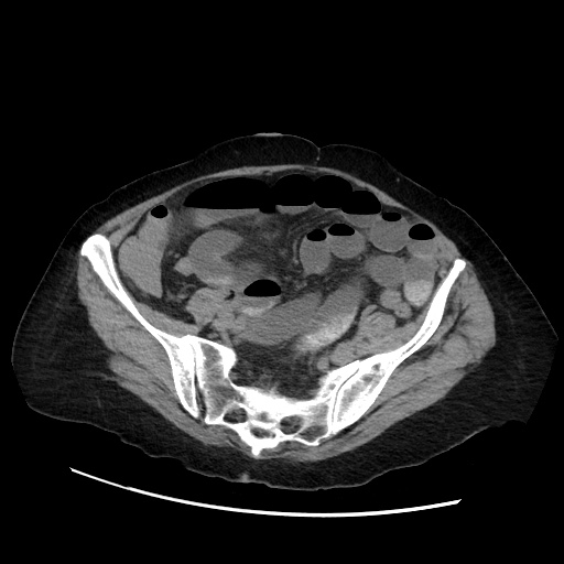 File:Closed loop small bowel obstruction due to adhesive band, with intramural hemorrhage and ischemia (Radiopaedia 83831-99017 Axial non-contrast 117).jpg