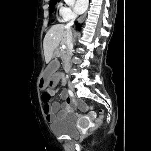 Closed loop small bowel obstruction due to adhesive band, with intramural hemorrhage and ischemia (Radiopaedia 83831-99017 D 96).jpg