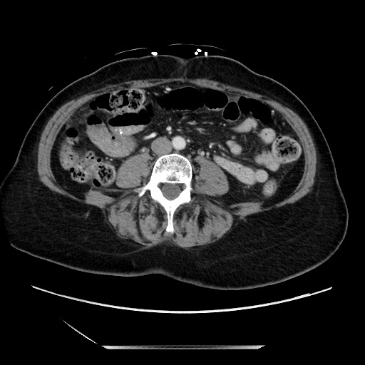 File:Closed loop small bowel obstruction due to adhesive bands - early and late images (Radiopaedia 83830-99014 A 83).jpg