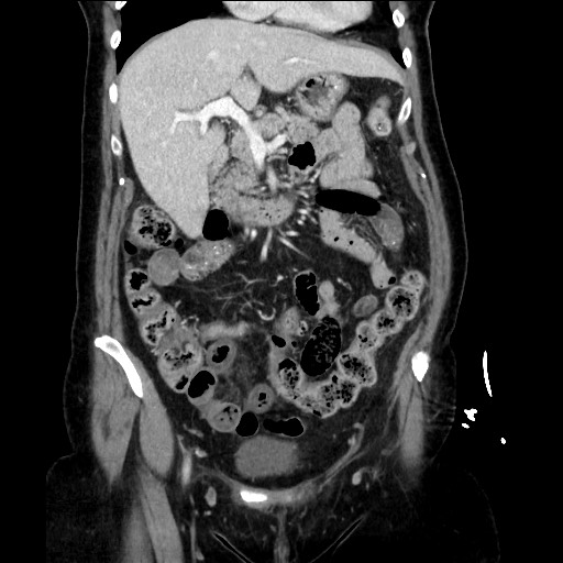 Closed loop small bowel obstruction due to adhesive bands - early and late images (Radiopaedia 83830-99014 B 48).jpg