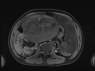 Closed loop small bowel obstruction in pregnancy (MRI) (Radiopaedia 87637-104031 Axial T1 fat sat 66).jpg