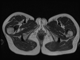 Closed loop small bowel obstruction in pregnancy (MRI) (Radiopaedia 87637-104031 D 47).jpg