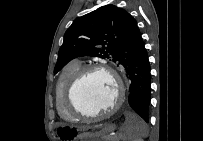 Coarctation of aorta with aortic valve stenosis (Radiopaedia 70463-80574 B 143).jpg