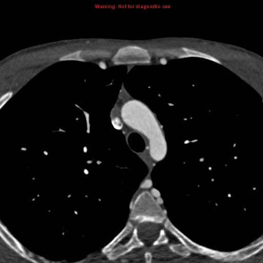 File:Coarctation of the aorta (Radiopaedia 12461-12697 A 63).jpg
