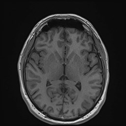 File:Cochlear incomplete partition type III associated with hypothalamic hamartoma (Radiopaedia 88756-105498 Axial T1 105).jpg
