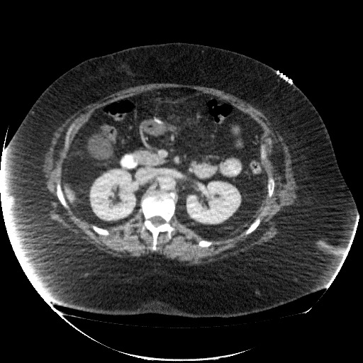 File:Collection due to leak after sleeve gastrectomy (Radiopaedia 55504-61972 A 34).jpg