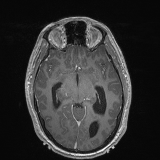 File:Colloid cyst (Radiopaedia 44510-48181 Axial T1 C+ 81).png