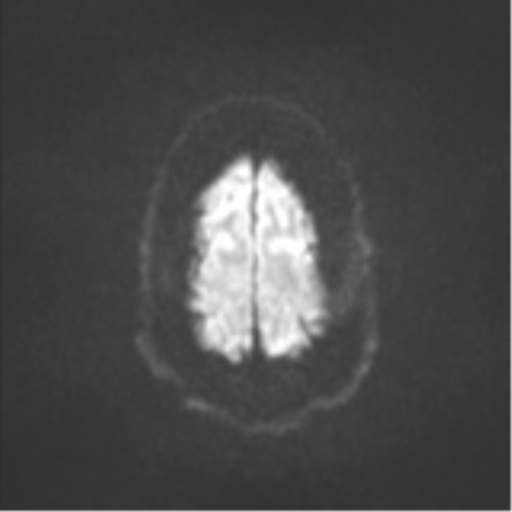 Colloid cyst (Radiopaedia 53164-59125 Axial DWI 53).png