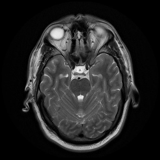 File:Colloid cyst with anterior communicating artery aneurysm (Radiopaedia 33901-35091 Axial T2 8).jpg