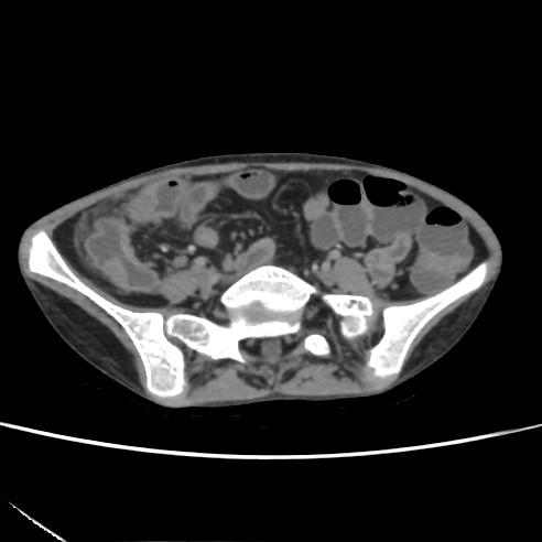 File:Colocolic fistula - Crohn disease (Radiopaedia 57063-63955 A 59).jpg