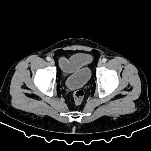 Colocolic intussusception due to large lipoma (Radiopaedia 68773-78482 A 174).jpg