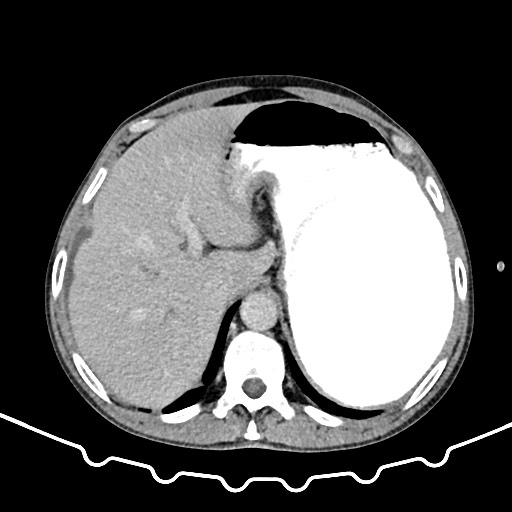 File:Colocolic intussusception due to large lipoma (Radiopaedia 68773-78482 A 27).jpg